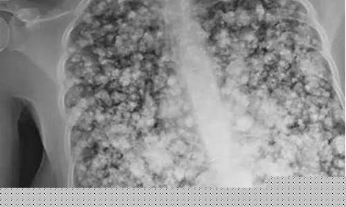 电子烟爆米花肺(电子烟爆米花肺事件)